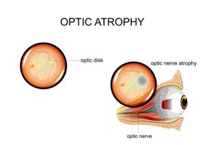 Restoring Vision After Optic Nerve Damage: Current Perspectives