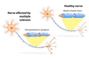 Can Myelin Damage Be Reversed? Insights on Multiple Sclerosis