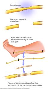 Do Damaged Nerves Heal? Understanding Nerve Regeneration