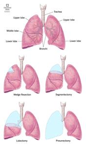 Lung Repair Timeline After Quitting Smoking