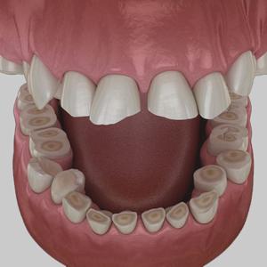 Can Tooth Enamel Be Restored? Understanding Remineralization