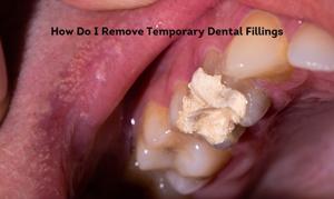 Temporary Tooth Filling at Home: A Guide